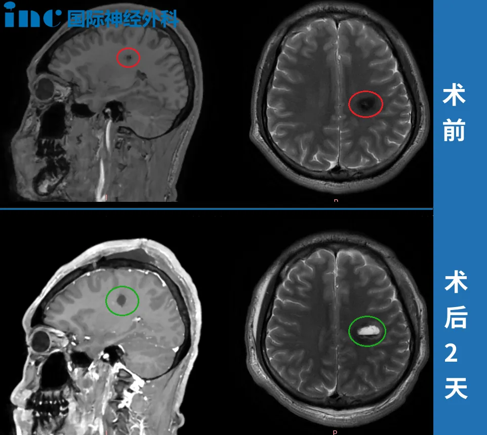 術(shù)前術(shù)后MRI影像對(duì)比