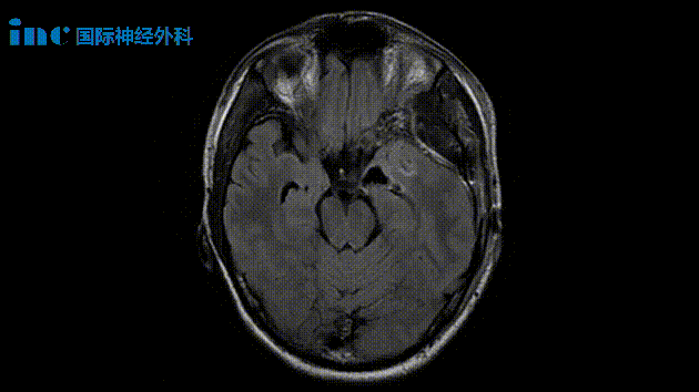 患者術(shù)前影像圖片