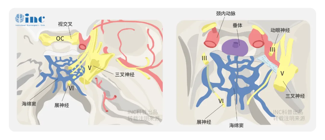 棘手的Meckel’s腔腦膜瘤該如何處理？