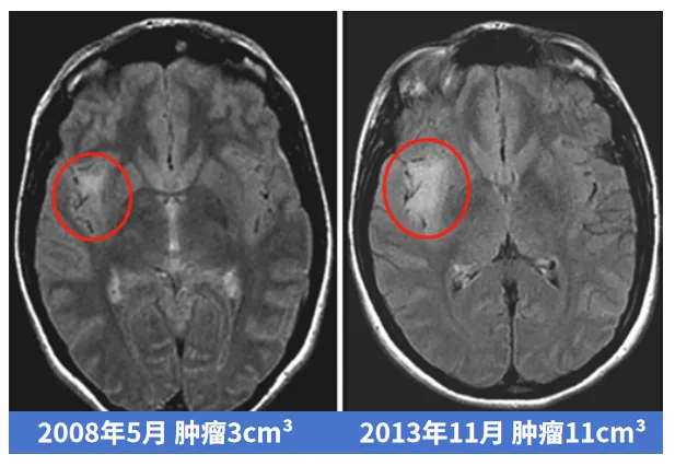 腫瘤發(fā)展進(jìn)程變化