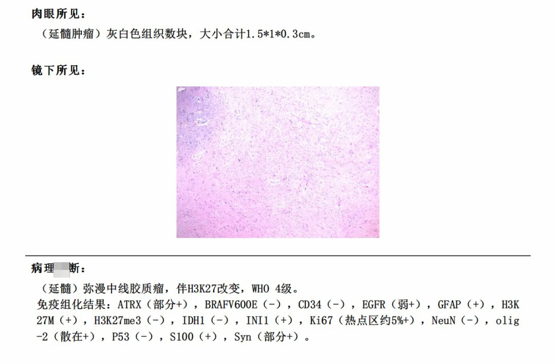 49歲男性-低級別膠質(zhì)瘤術(shù)后竟是四級