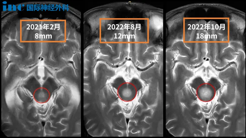 21歲男性-腦干低級別膠質(zhì)瘤，2個月迅速生長8mm