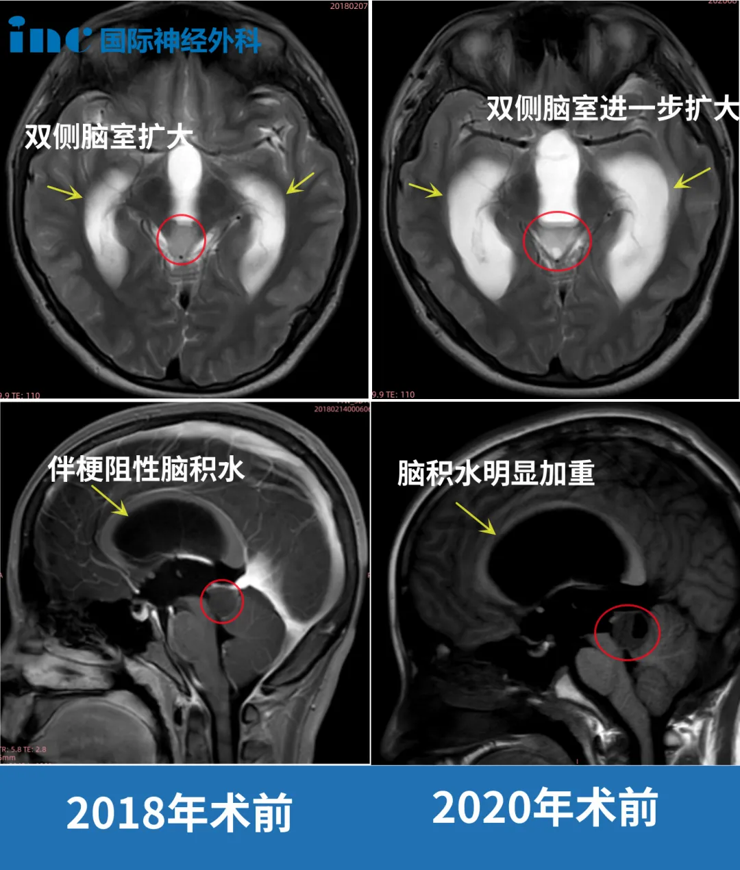 14歲男孩-腦干膠質(zhì)瘤2年壓扁腦干導(dǎo)致腦積水