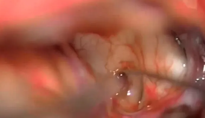 腫瘤充滿三腦室
