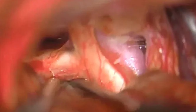 使用cusa進(jìn)行腫瘤大部分減容