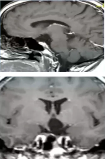 術(shù)后MRI，顯示解剖性全切除