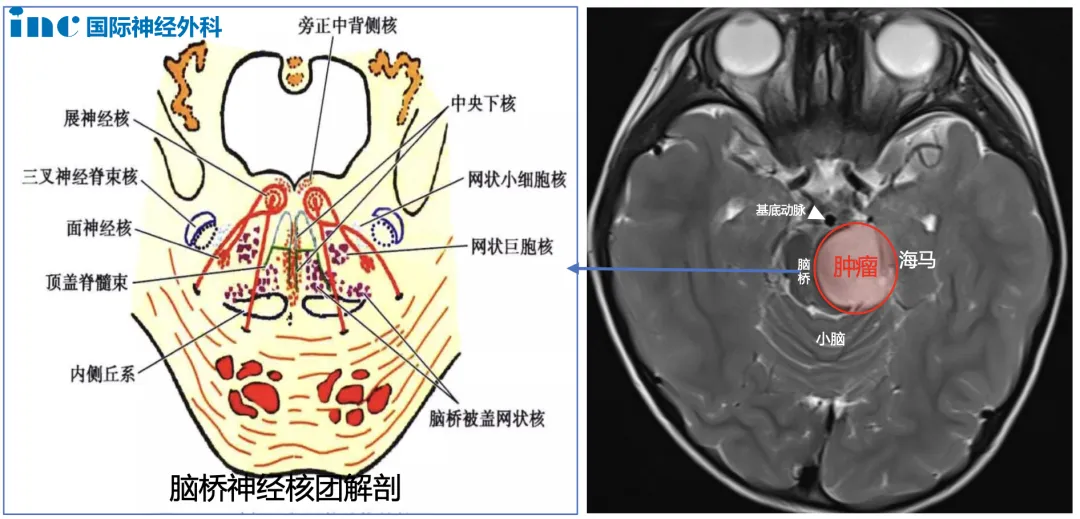 兒童腦干膠質(zhì)瘤