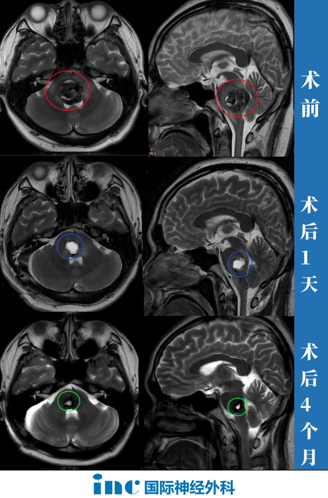 腦干海綿狀血管瘤患者術前術后影像對比圖片