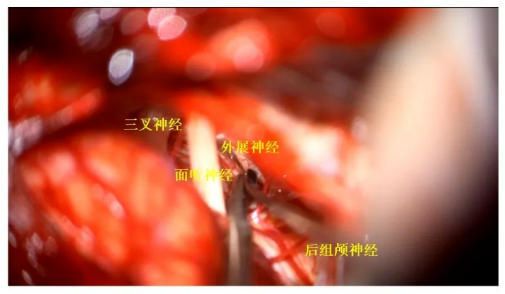 三叉神經、面聽神經、外展神經、后組神經保護完好