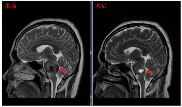 術后患者MRI顯示面丘結構恢復