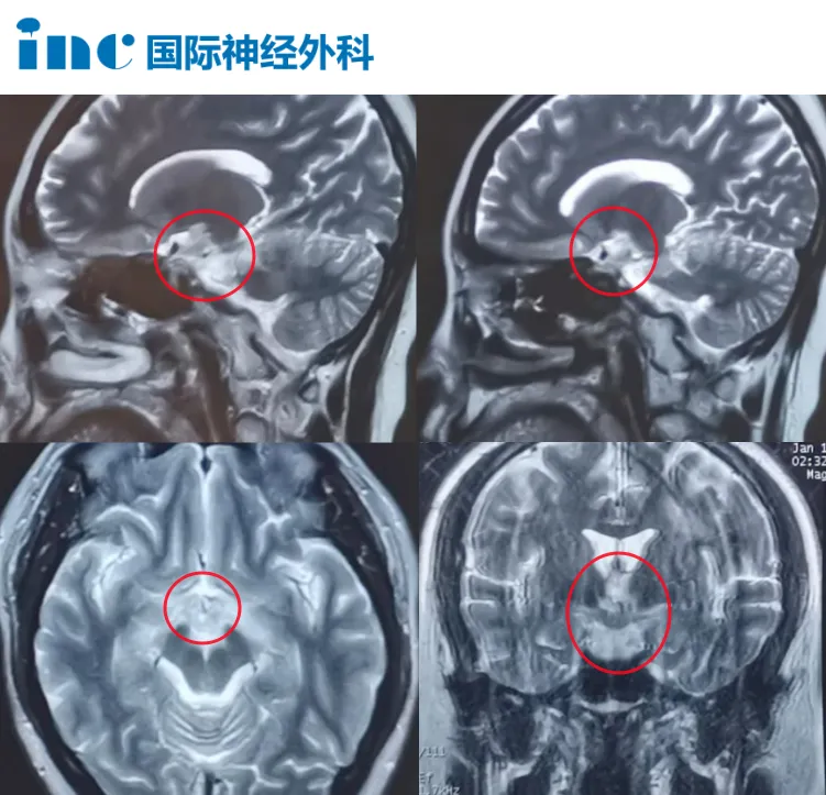 下丘腦病變?yōu)楹位顧z無法確診？