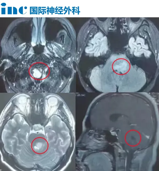 腦干-下丘腦病變