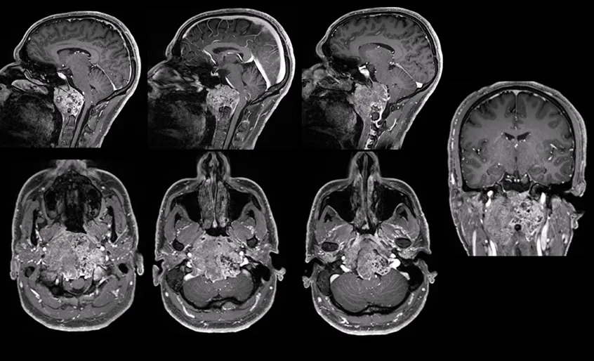 26歲男士-腫瘤較大壓迫腦干
