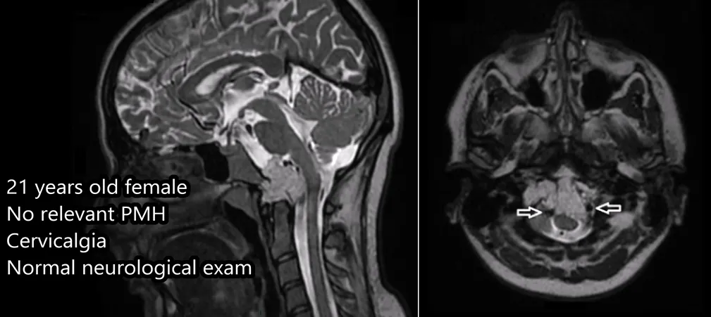 術(shù)前MRI