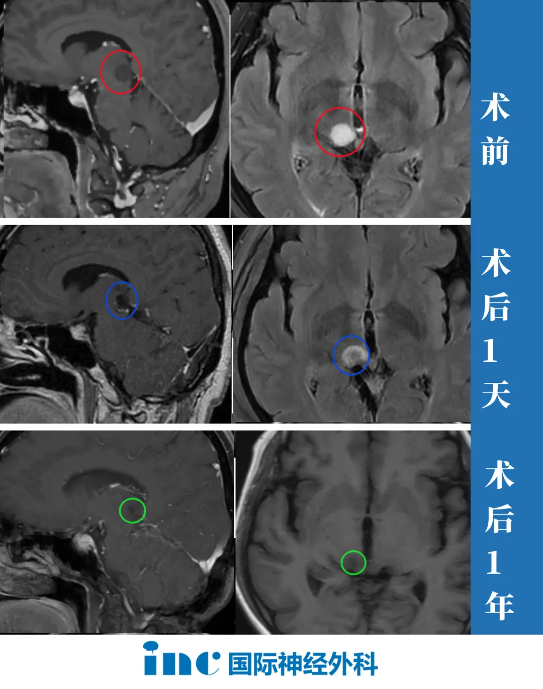 術(shù)后情況