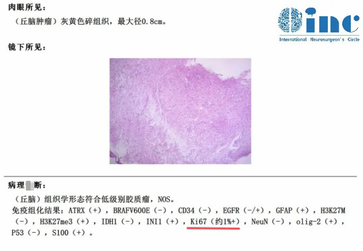 病理結(jié)果出來了，低級(jí)別膠質(zhì)瘤！Ki67約1%