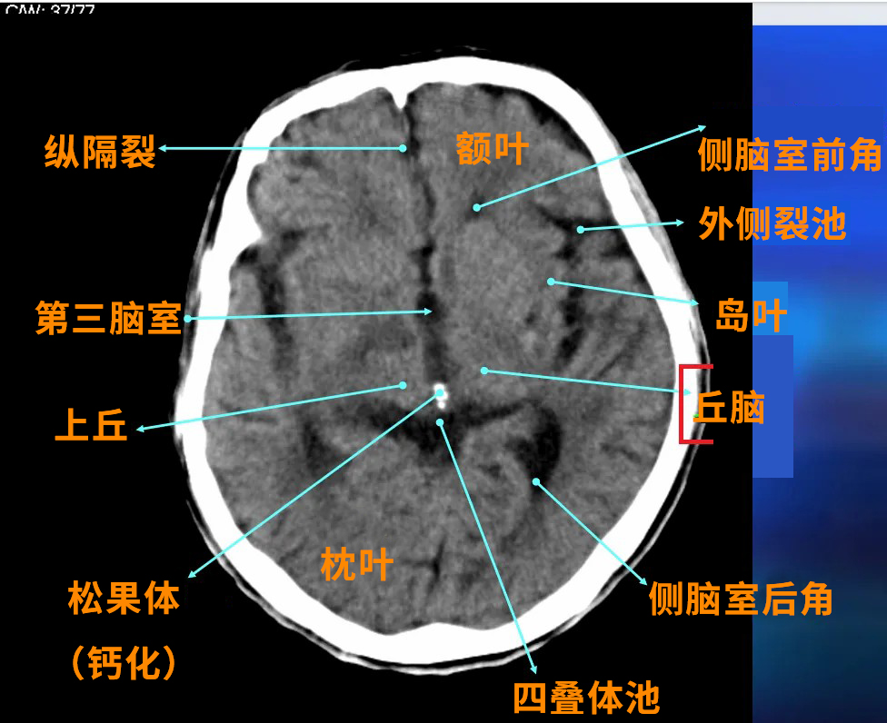 丘腦附近重要的鄰居有松果體、下丘腦、中腦。