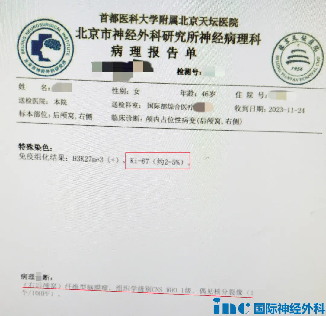 術(shù)后病理報告為1級纖維型腦膜瘤，預(yù)后良好