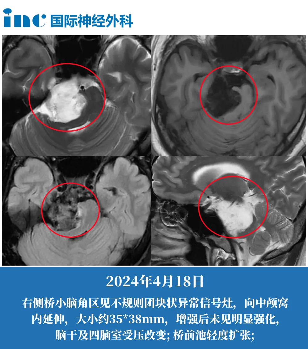 29歲男性-右側橋小腦角區(qū)占位