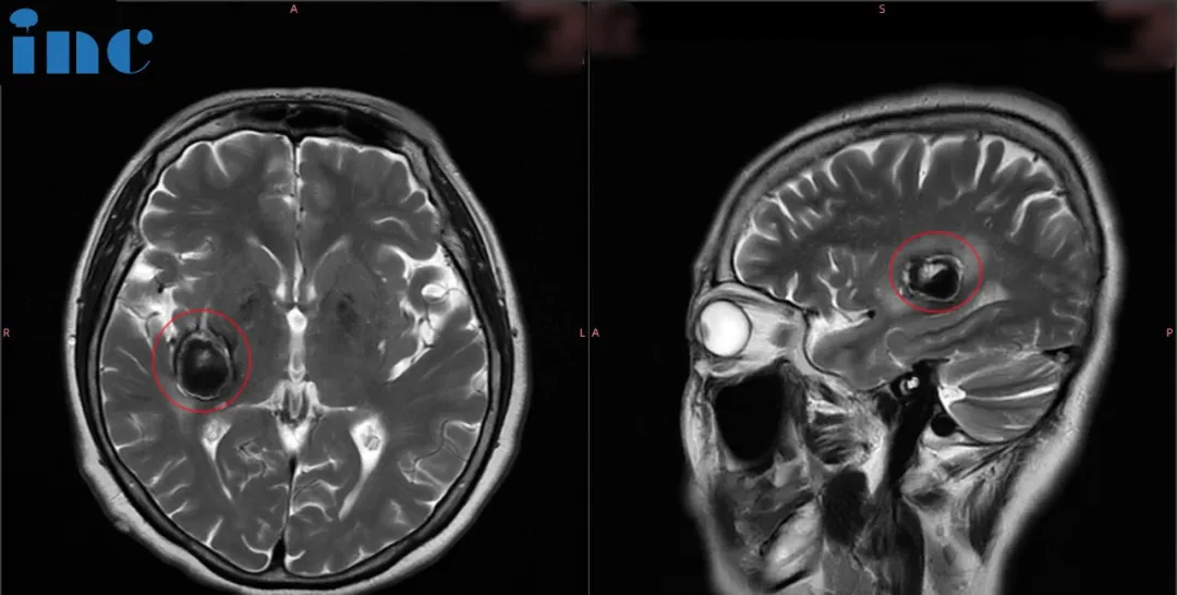 體檢查出少見海綿狀血管瘤，醫(yī)生說手術(shù)癱