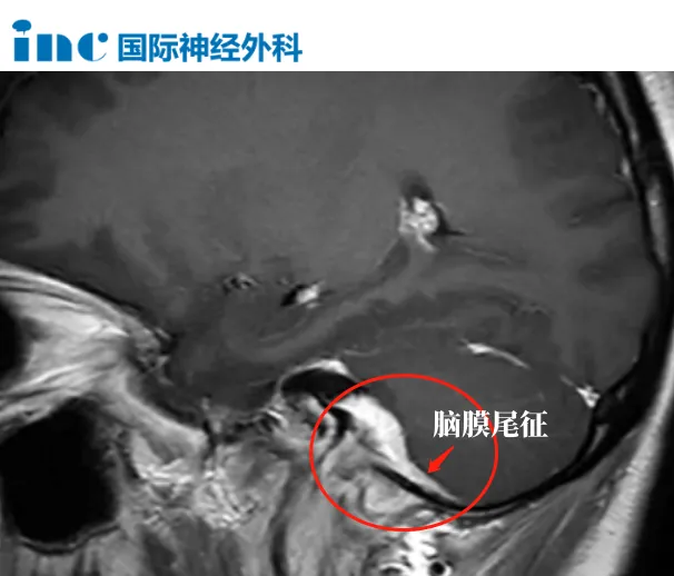 39歲女性-頸靜脈孔區(qū)腦膜瘤圖片