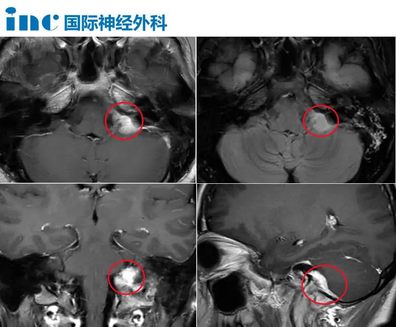 39歲女性-頸靜脈孔區(qū)腦膜瘤