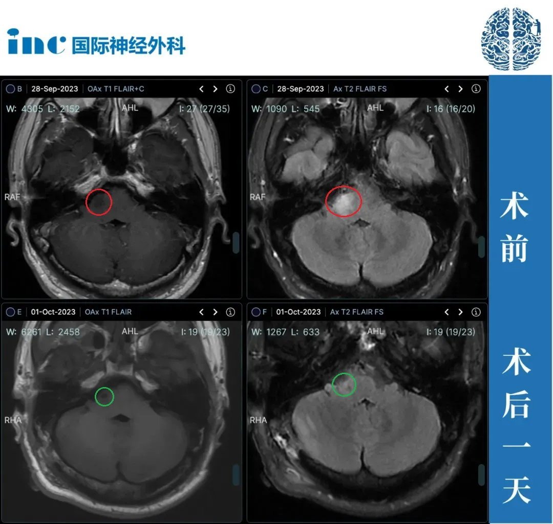 30歲男性—橋臂膠質(zhì)瘤