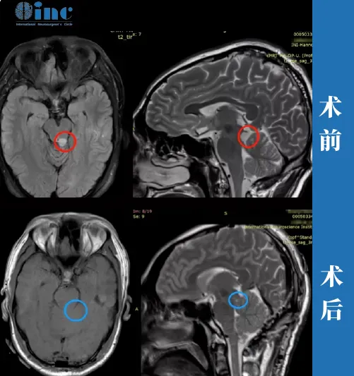 30歲男性—中腦頂蓋膠質(zhì)瘤
