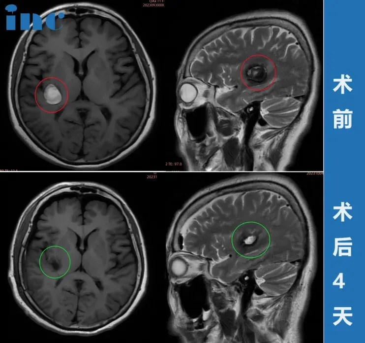 37歲女性—腦干海綿狀血管瘤