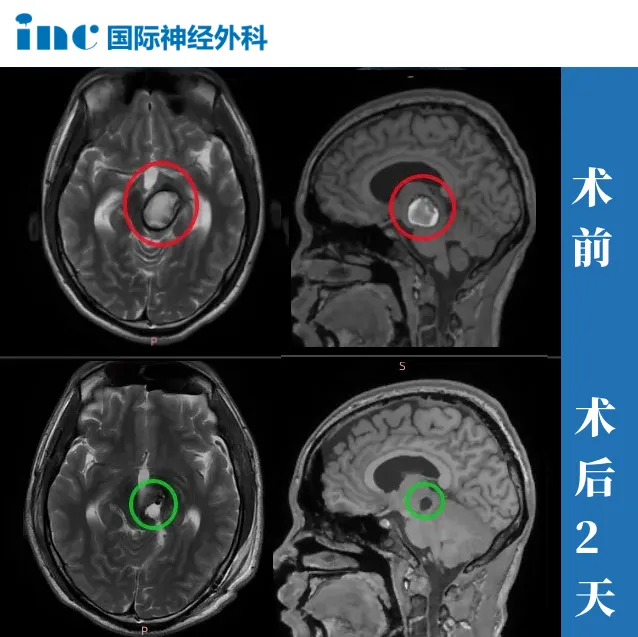 18歲男孩—腦干海綿狀血管瘤