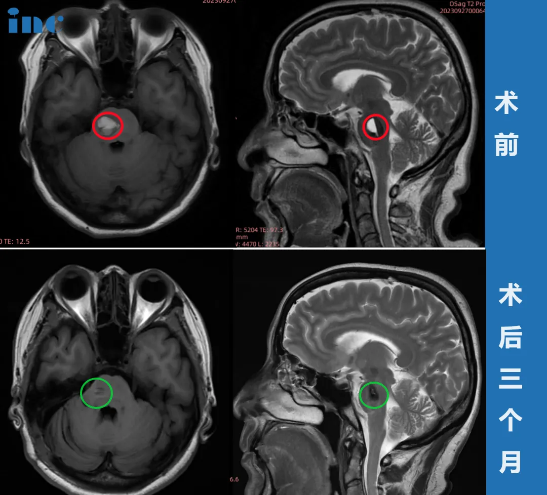 52歲女性—腦干海綿狀血管瘤