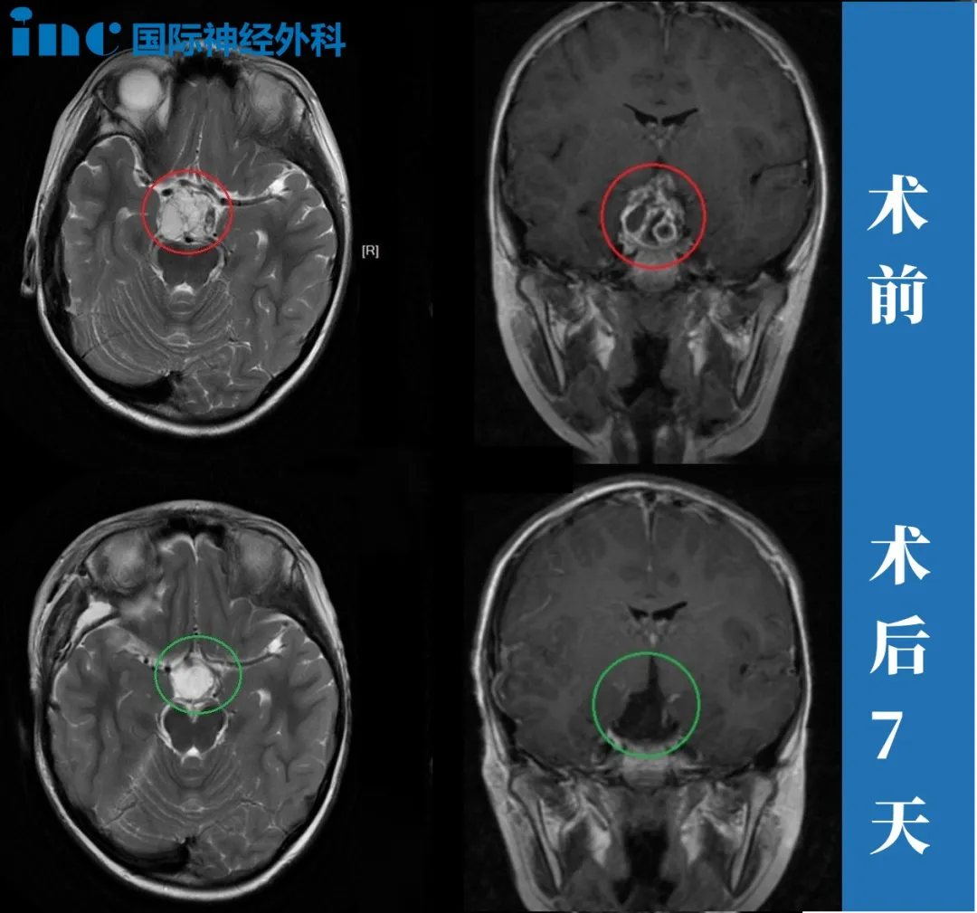 7歲男孩—顱咽管瘤