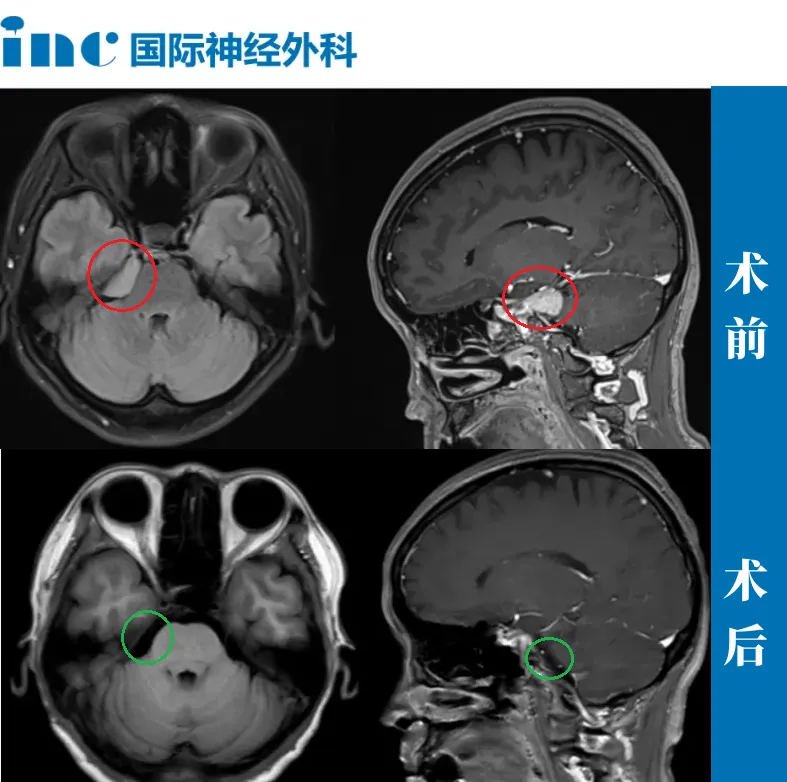 52歲女性—CPA區(qū)腦膜瘤