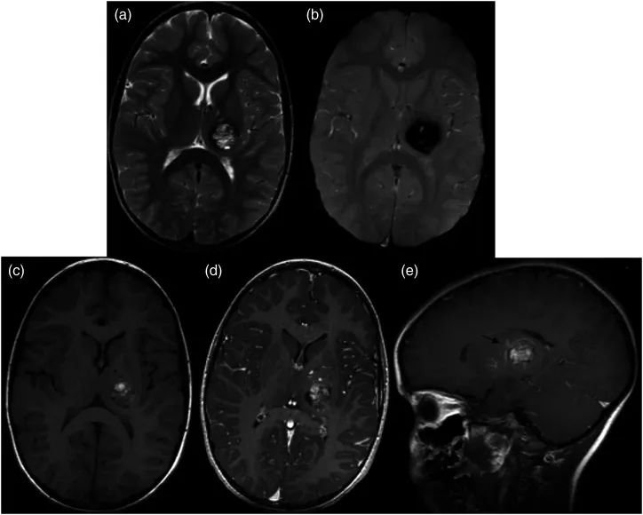 圖2：患者5歲時一次就診時的MRI。