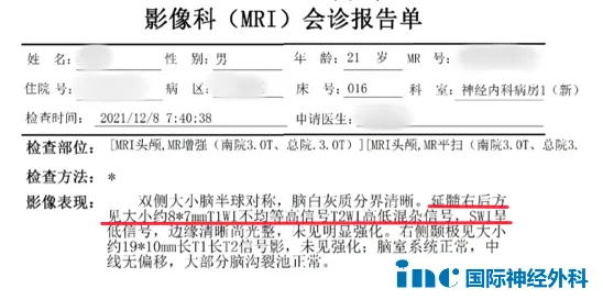 腦干海綿狀血管瘤