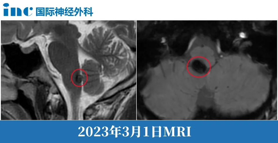 腦干海綿狀血管瘤