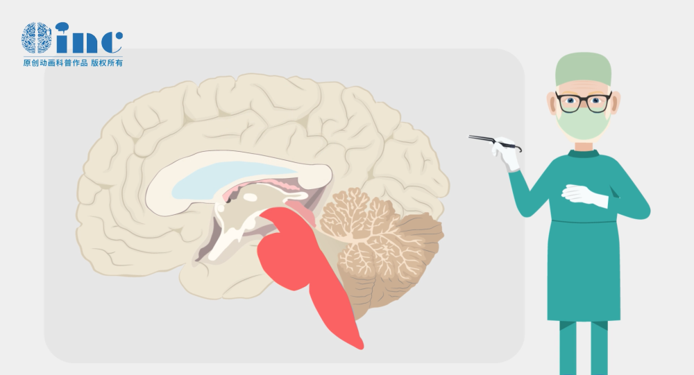 二次復發(fā)膠質瘤長腦干怎么辦?