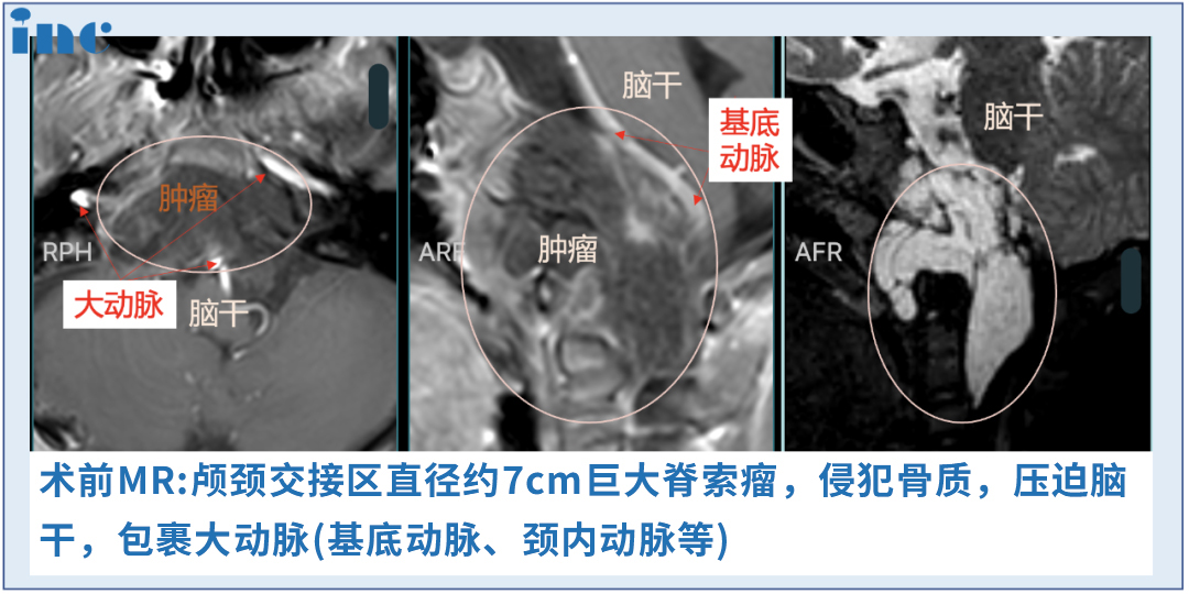 術(shù)前術(shù)后影像對比