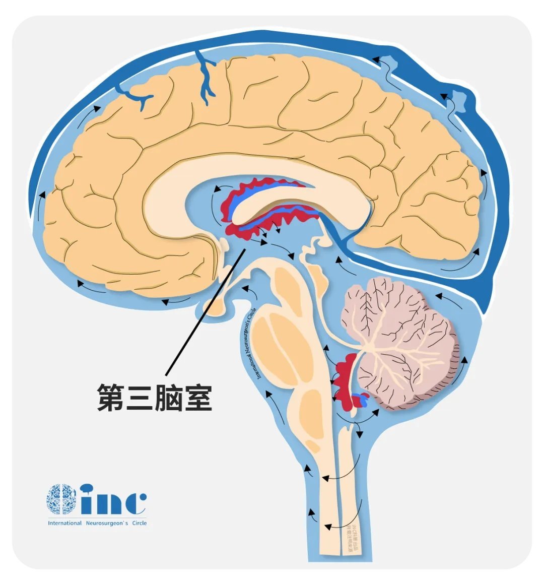 什么是腦脊液漏