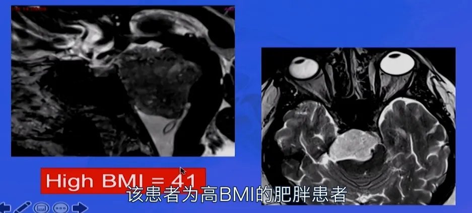 案例一：高MBI肥胖患者硬膜內脊索瘤，手術中可能會出現(xiàn)嚴重的腦脊液漏