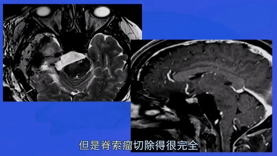 使用自體脂肪填充瘤腔及關顱