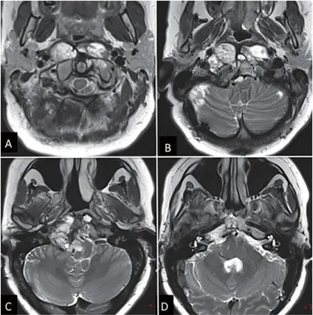 圖1：內鏡下鼻內鏡入路前的術前影像。(A-D)MRI T2 WI顯示一個較大脊索瘤延伸至椎前間隙和齒狀突周圍。腫瘤橫向延伸至舌下管和頸靜脈孔，并向內側延伸至硬膜內間隙。腫瘤從斜坡中部延伸至樞椎齒狀突周圍。