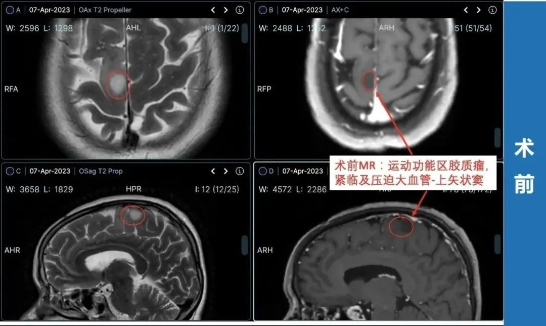 治療過(guò)程：4月2日，羅女士和家人一致決定找巴教授手術(shù)，這時(shí)距離羅女士咨詢巴教授僅過(guò)去了2天。