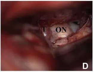 （D）腫瘤(T)外側(cè)的右視神經(jīng)(ON)。