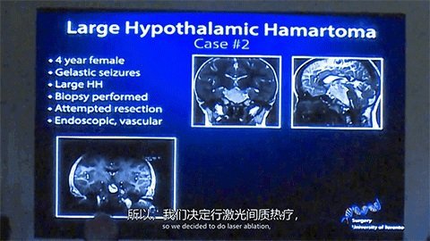 LITT技術(shù)消融元兇下丘腦錯(cuò)構(gòu)瘤