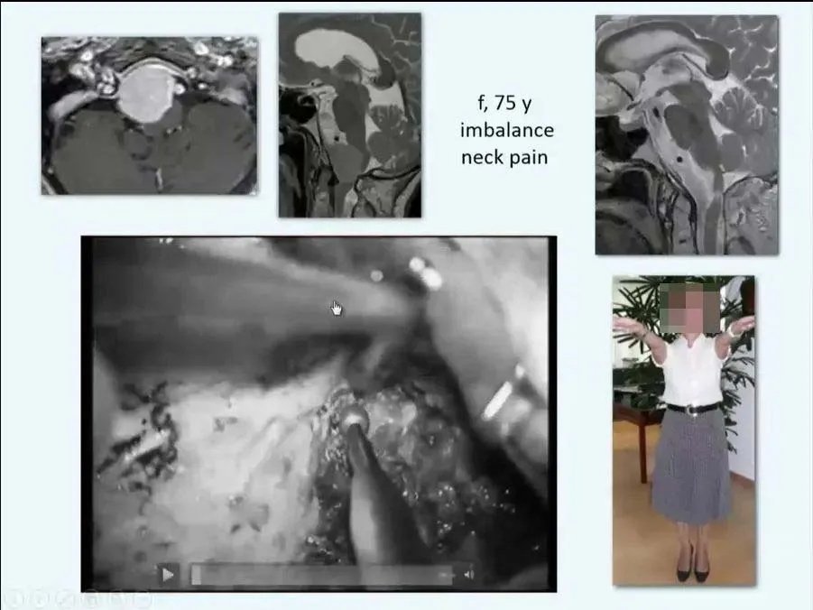 INC巴教授枕骨大孔區(qū)腦膜瘤精彩案例交流