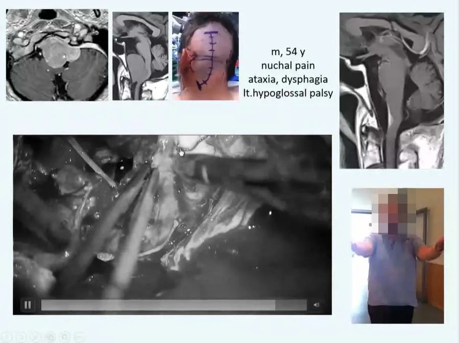 INC巴教授枕骨大孔區(qū)腦膜瘤精彩案例交流