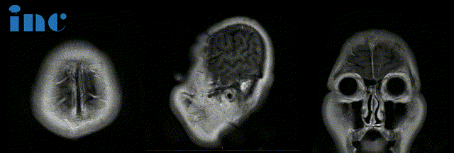 面對(duì)少見脊索瘤三年三次復(fù)發(fā)的挑戰(zhàn)，堅(jiān)持抗?fàn)幨欠褚廊怀錆M希望？