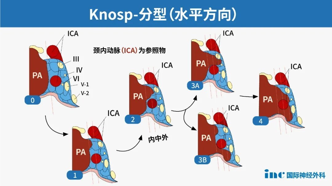 冠狀位上通過(guò)頸內(nèi)動(dòng)脈內(nèi)側(cè)緣、中心、外側(cè)緣作三條連線，通過(guò)評(píng)估垂體腺瘤與這三條線的關(guān)系做出分級(jí)分類(lèi)