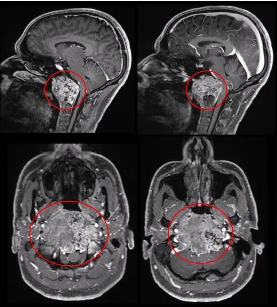 術(shù)前MRI